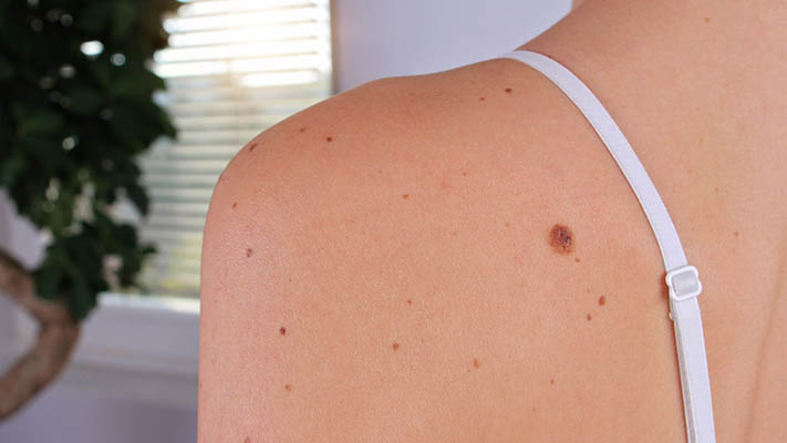 How To Remove Skin Tags In One Day