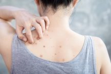 Back Acne (Bacne): How to Get Rid of It, How to Prevent It, Treatment